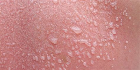 How Long Sunburn Blisters Last and How to Get Rid。